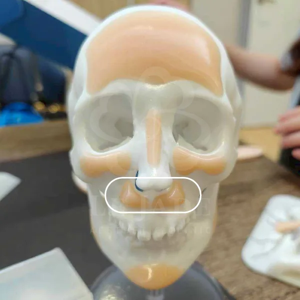 3D列印,完形美,鼻基底填補,鼻溝槽填補,臉部凹陷,法令紋,嘴凸