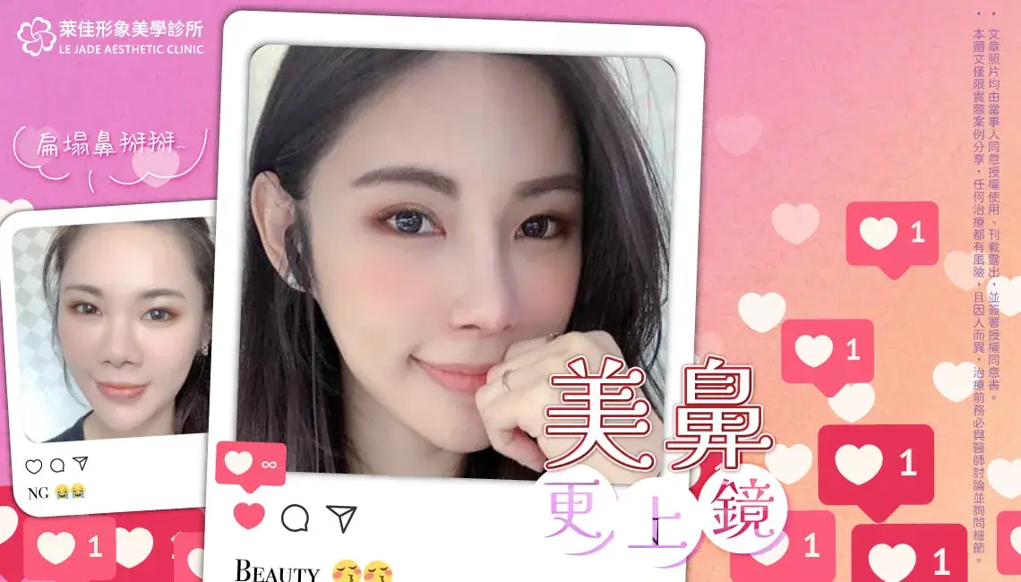 【Goretex隆鼻+縮鼻翼+鼻中膈延長手術】改善埋線短鼻隆鼻分享!