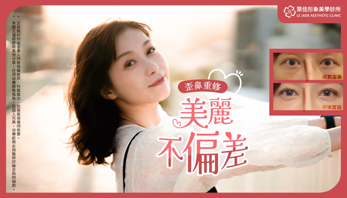 【隆鼻重修】初次隆鼻失敗鼻子歪掉,重修手術拯救歪鼻,Goretex+半自肋隆鼻案例分享
