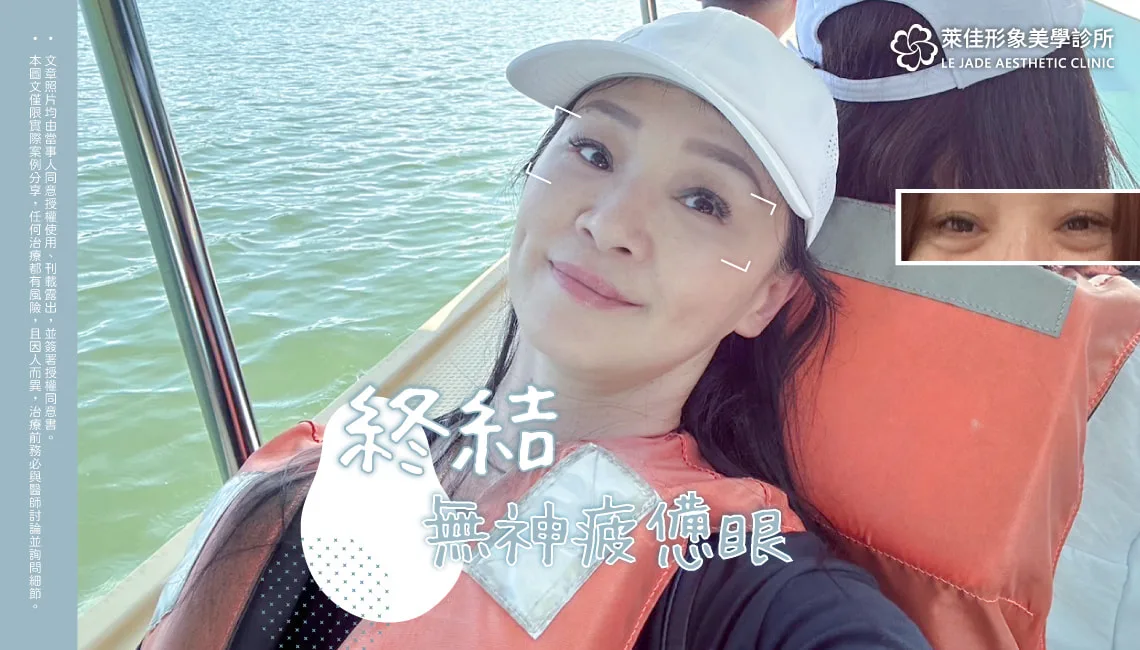【眼袋外開手術+補脂】終結無神老態疲憊眼，眼袋外開案例分享