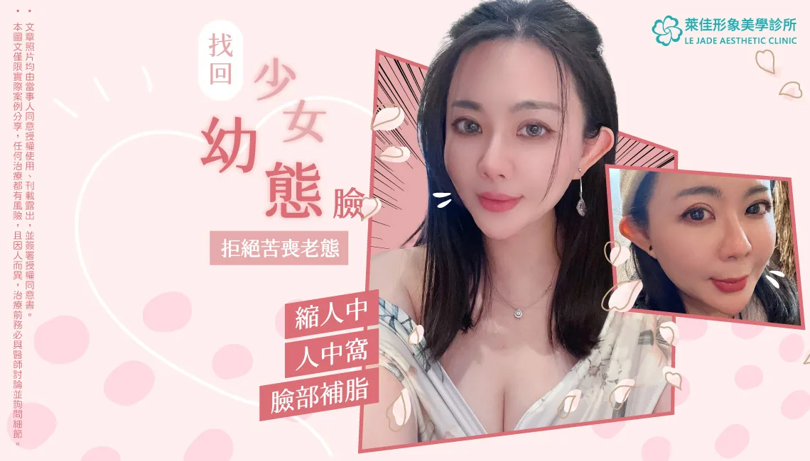 【縮人中+人中窩+臉部補脂】簡單小手術就能恢復年輕，幼態臉手術分享