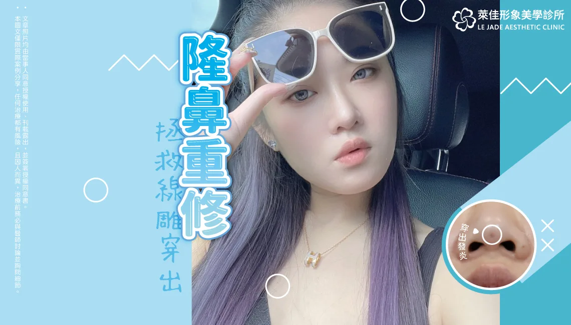 【隆鼻重修】埋線隆鼻線頭穿出！Goretex複合式隆鼻手術案例分享