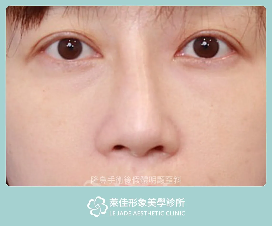 隆鼻失敗案例，隆鼻假體嚴重歪斜