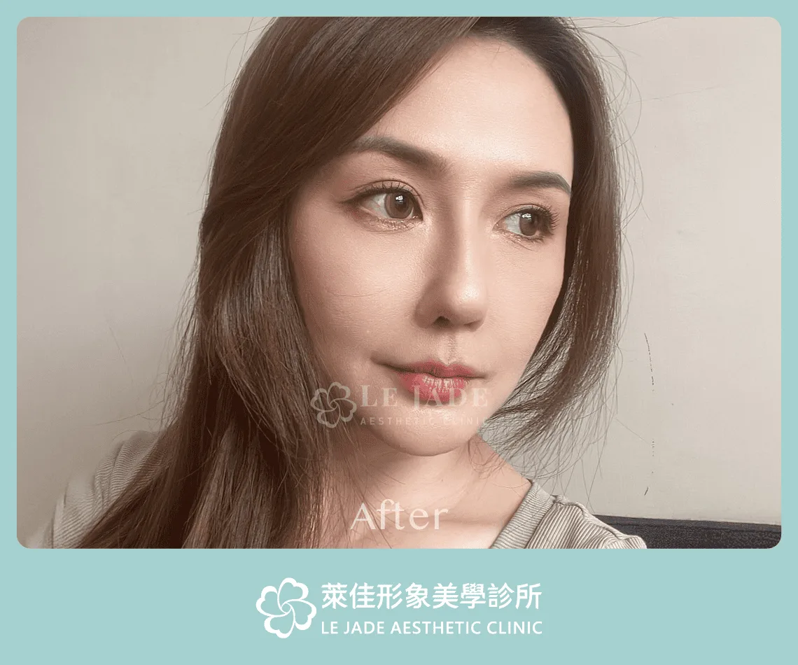 3D列印完形美隆鼻+肋骨隆鼻案例分享 隆鼻後照片