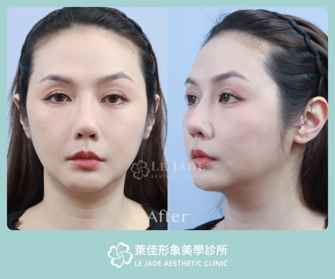 3D列印完形美隆鼻+肋骨隆鼻案例分享 隆鼻後正面及側面照