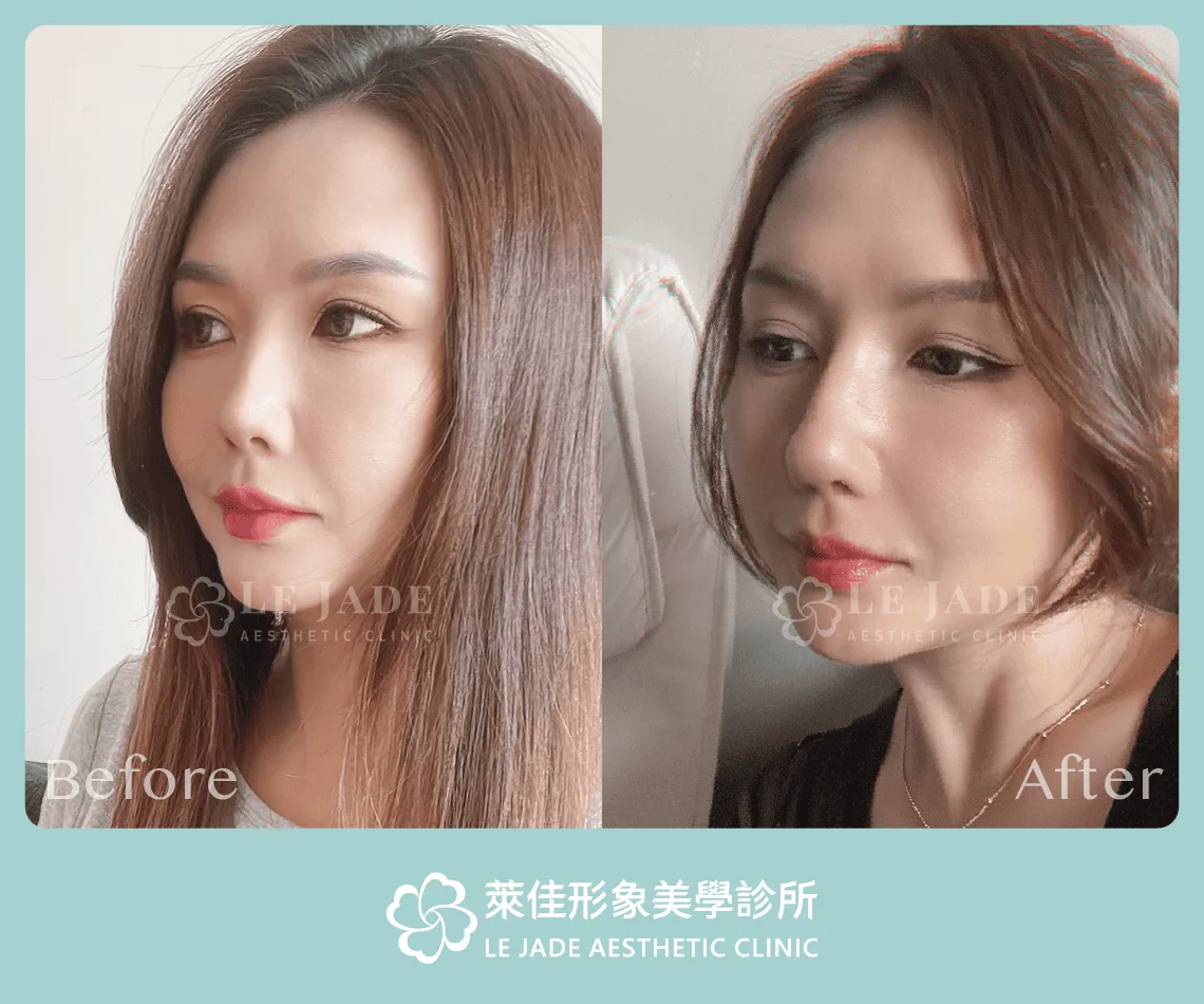 3D列印完形美隆鼻+肋骨隆鼻案例分享 隆鼻前後對比照 側面