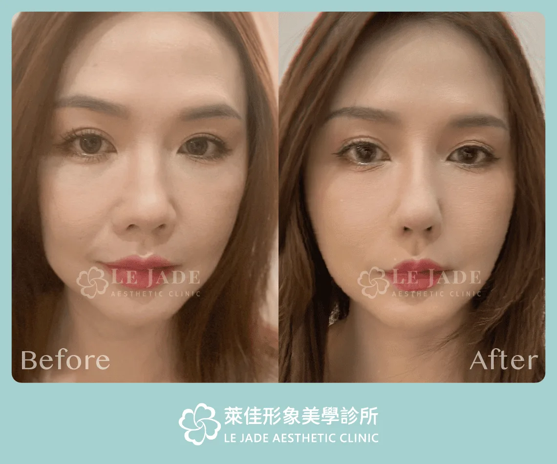 3D列印完形美隆鼻+肋骨隆鼻案例分享 隆鼻前後對比照 正面