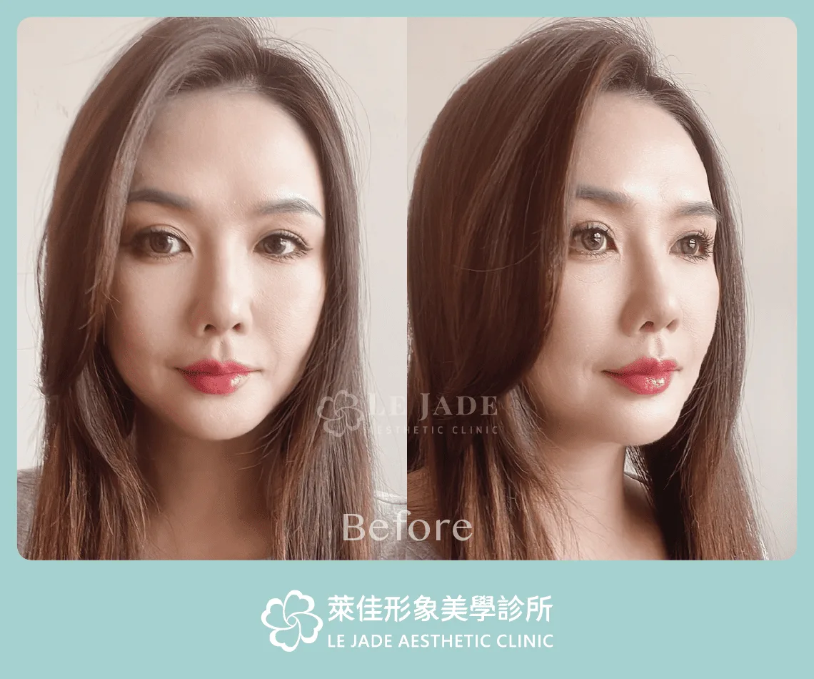 3D列印完形美隆鼻+肋骨隆鼻案例分享 隆鼻前照片