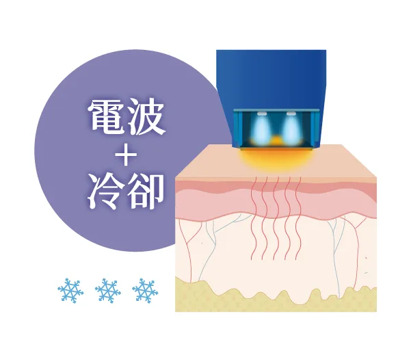 十蓓電波冷卻系統術中降溫