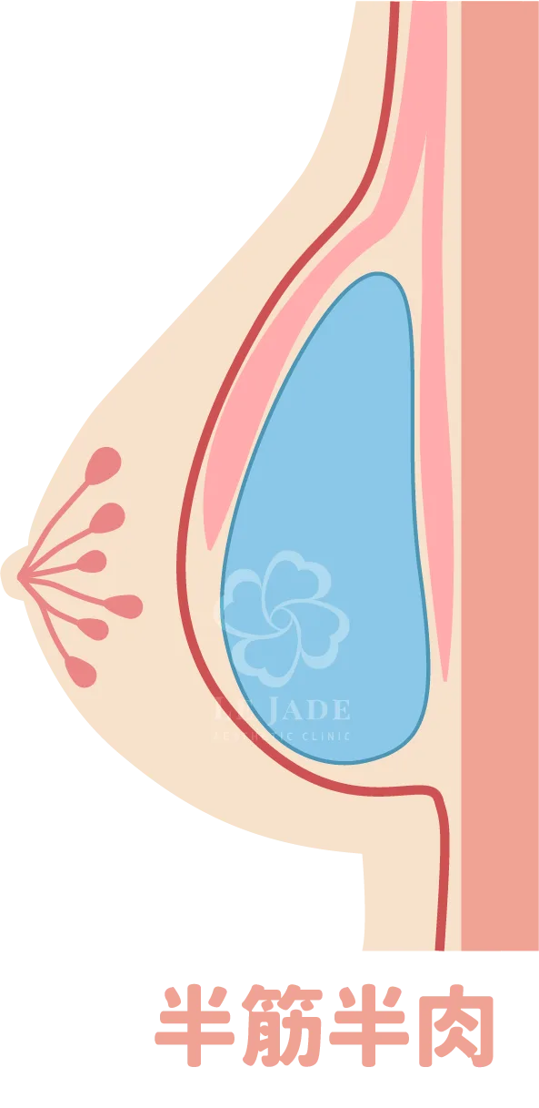 隆乳手術,隆乳放置位置,隆乳材質