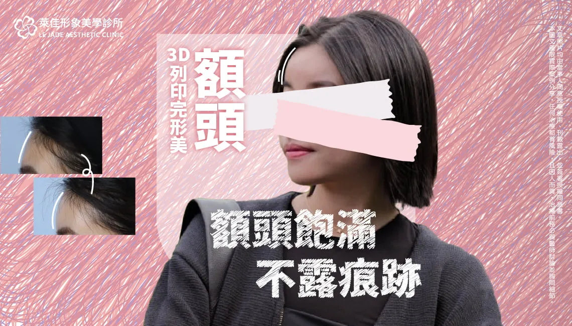 【完形美豐額】3D列印立體額頭，完美側顏