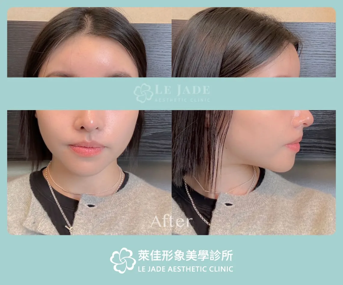 3D列印豐額手術後一個月