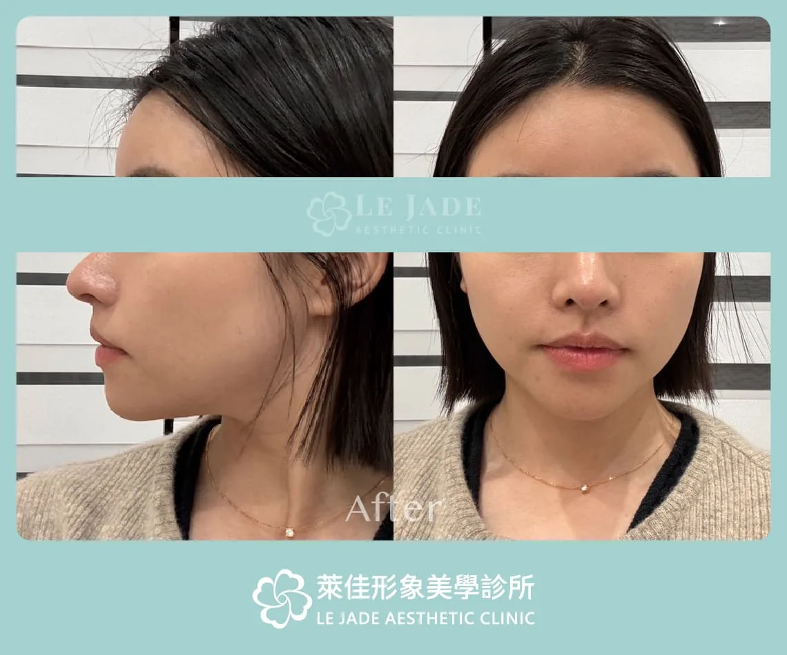 豐額手術後3個月,原生額頭感
