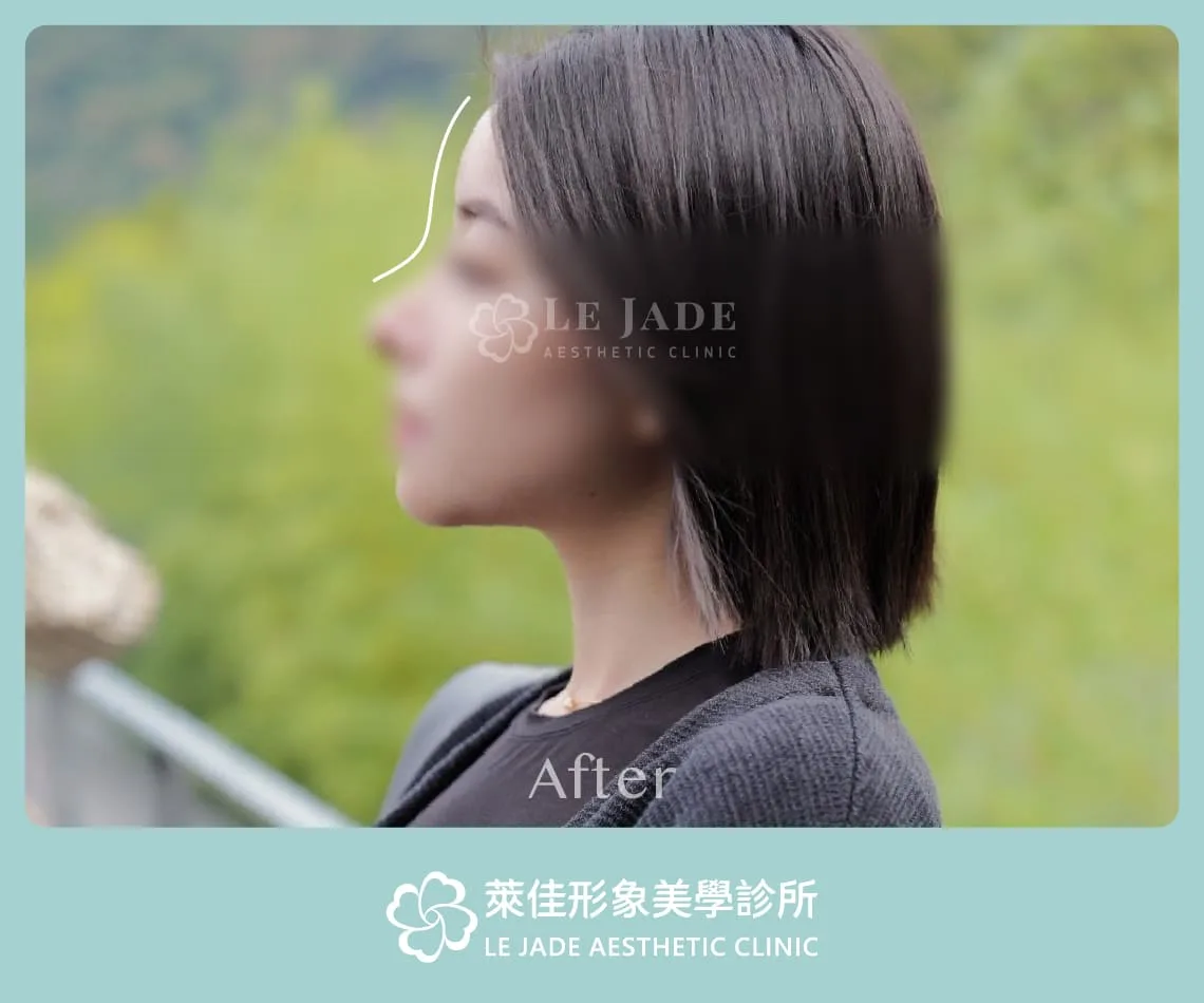 豐額手術後側面立體好看