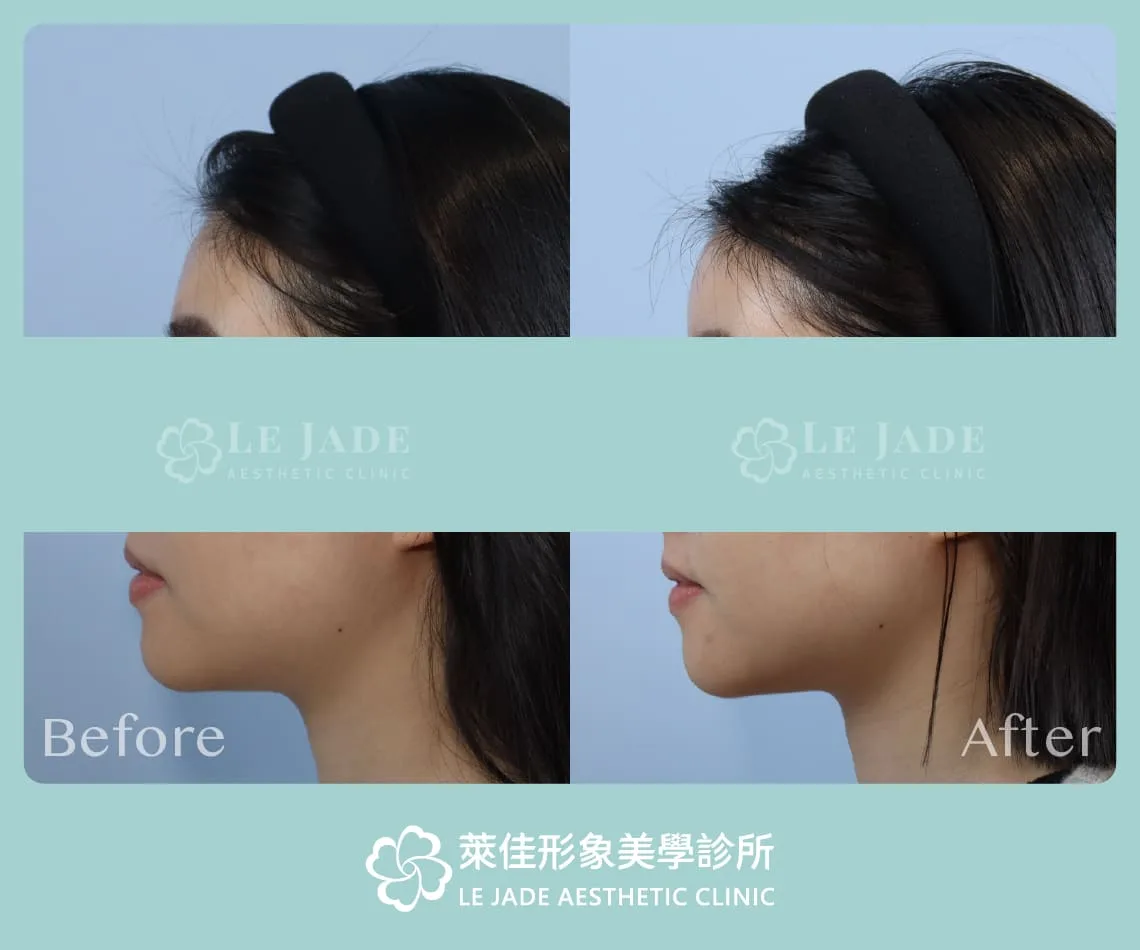 3D列印豐額手術前後對比照