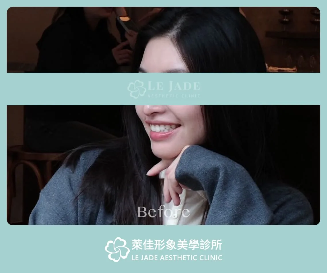 豐額手術前,打亮也沒辦法改善側面立體度