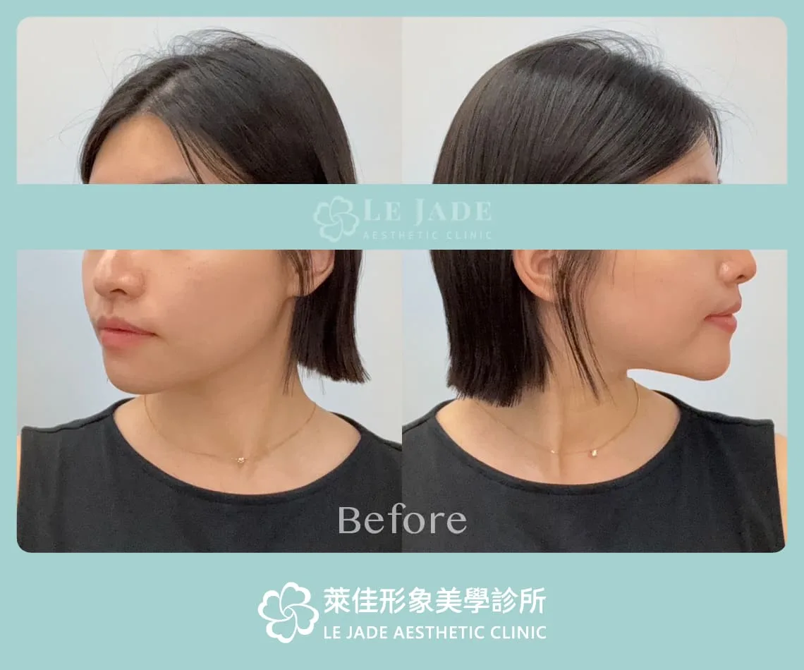 豐額手術前,較扁平的額頭