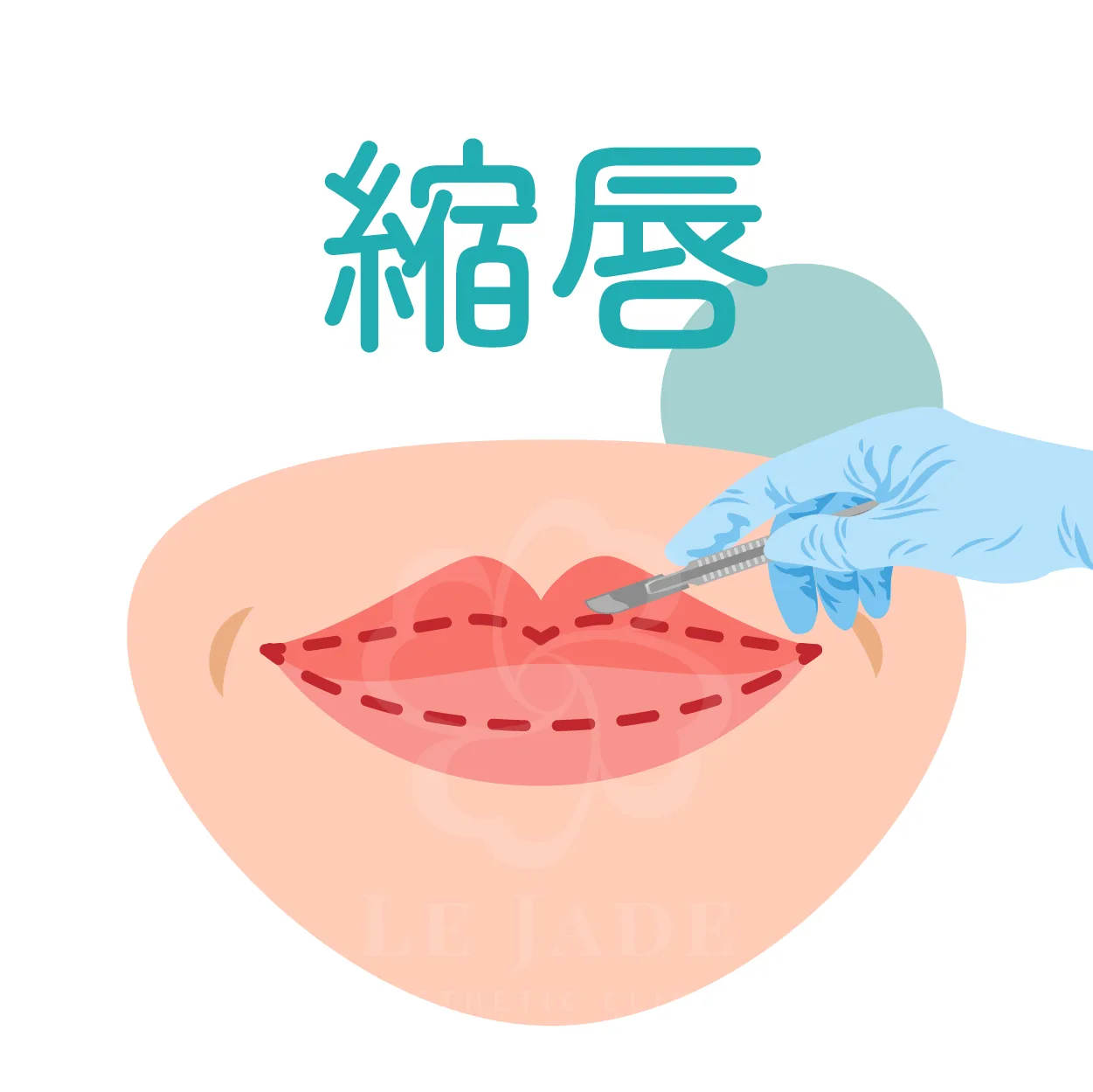 縮唇手術,縮唇,厚唇,微笑唇,厚唇縮小,縮唇微笑線,上下唇比例,客製化縮唇,薄唇雕塑