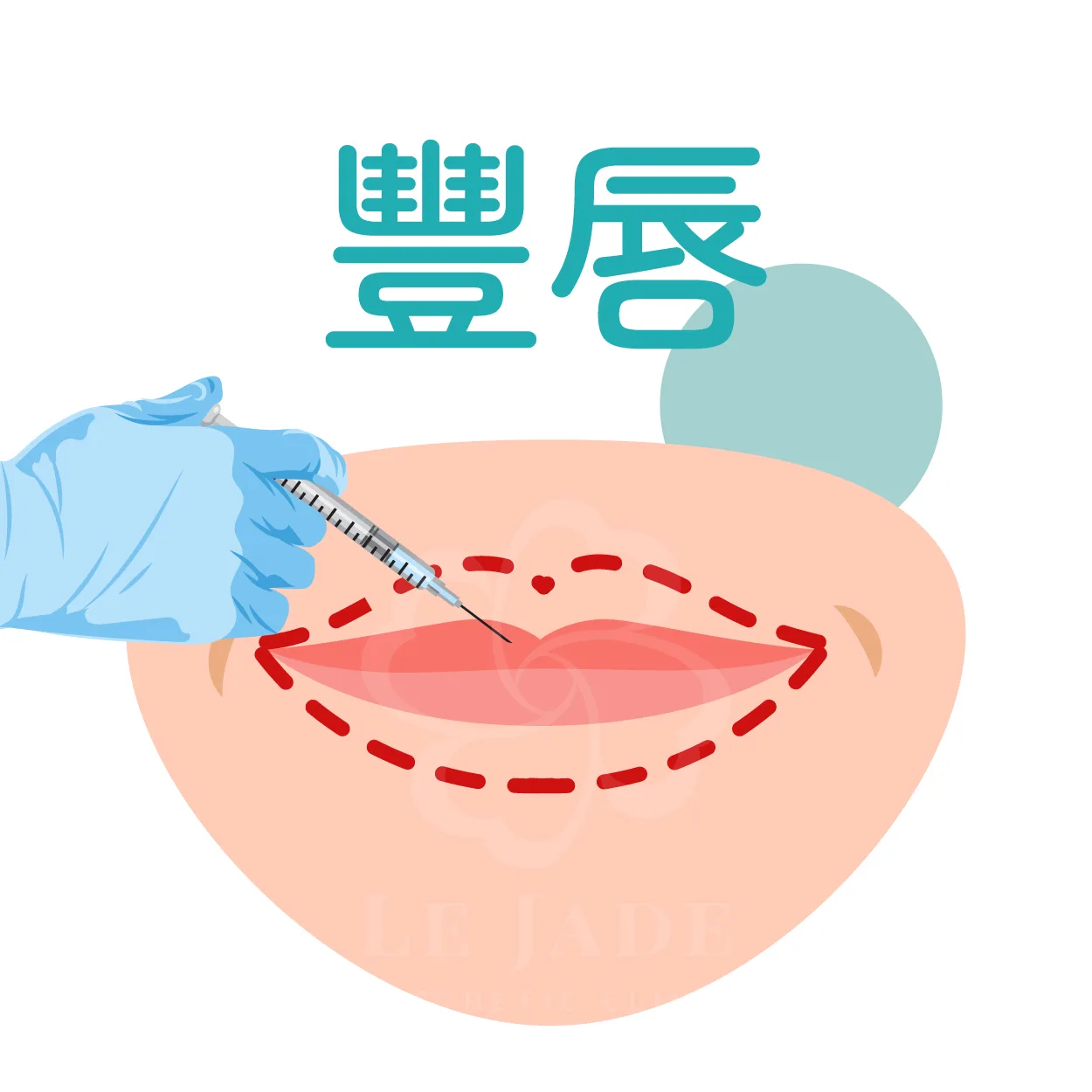 縮唇手術,縮唇,厚唇,微笑唇,厚唇縮小,縮唇微笑線,上下唇比例,客製化縮唇,薄唇雕塑