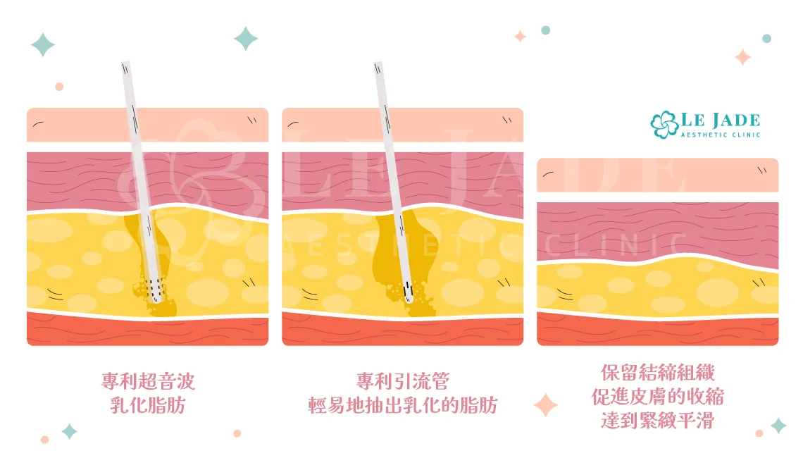 威塑抽脂原理為利用超音波能量乳化脂肪後抽出