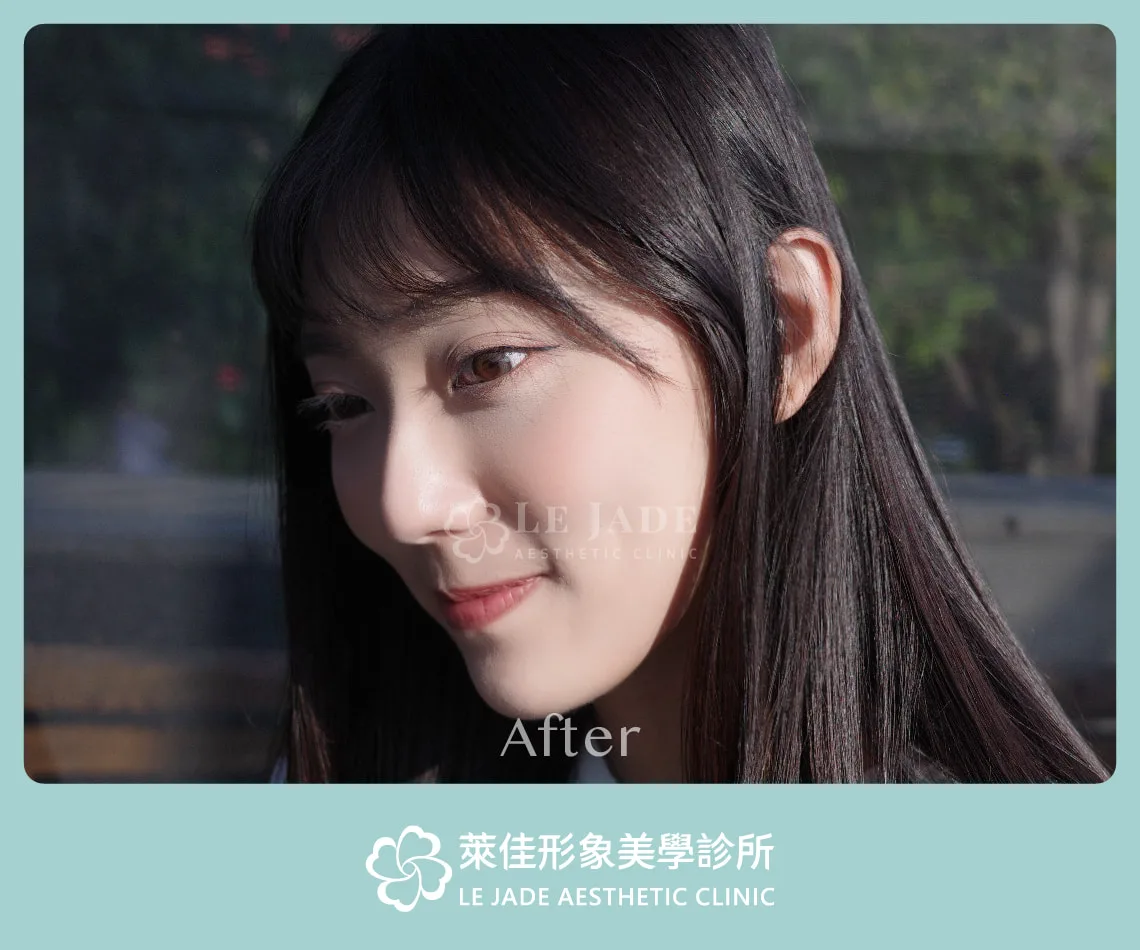 眼袋手術後1個月