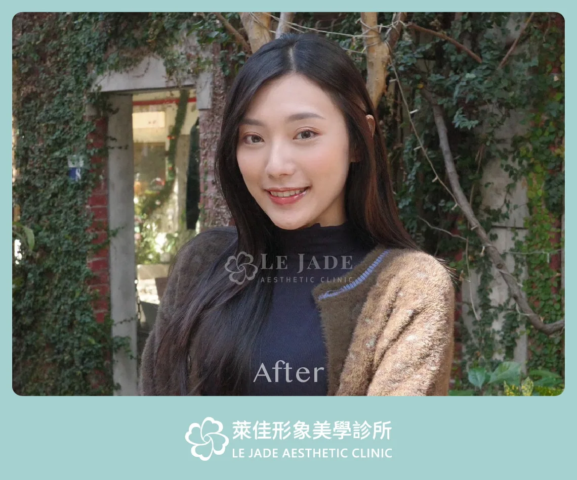 眼袋手術後2個月