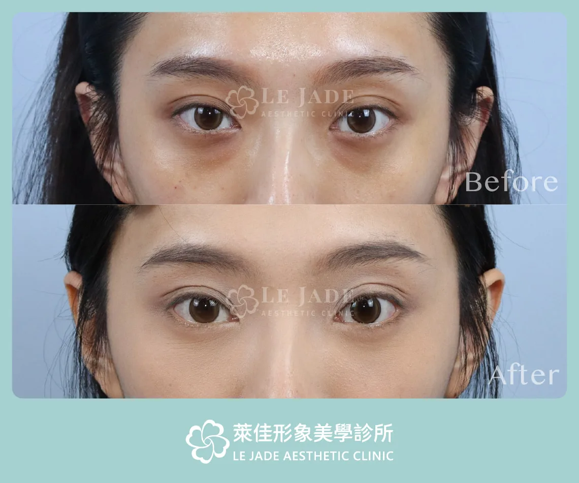 眼袋手術前後對比照
