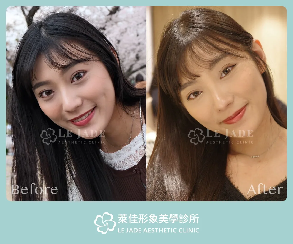 眼袋手術前後對比照