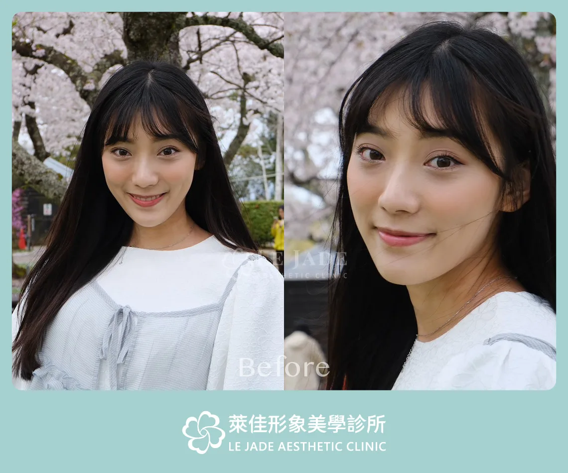 眼袋內開手術，術前眼袋及黑眼圈明顯