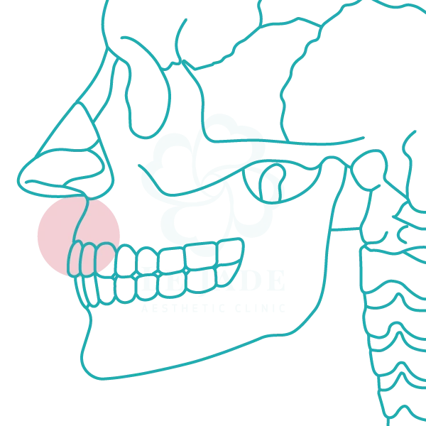 3D列印,完形美,鼻基底填補,鼻溝槽填補,臉部凹陷,法令紋,嘴凸