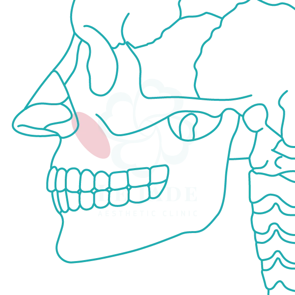 3D列印,完形美,鼻基底填補,鼻溝槽填補,臉部凹陷,法令紋,嘴凸