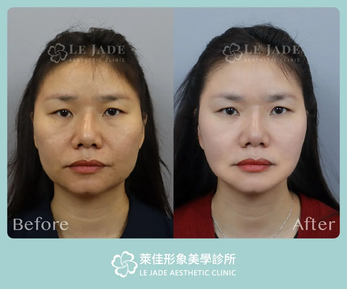 萊佳中下臉拉皮手術 術前術後對比照