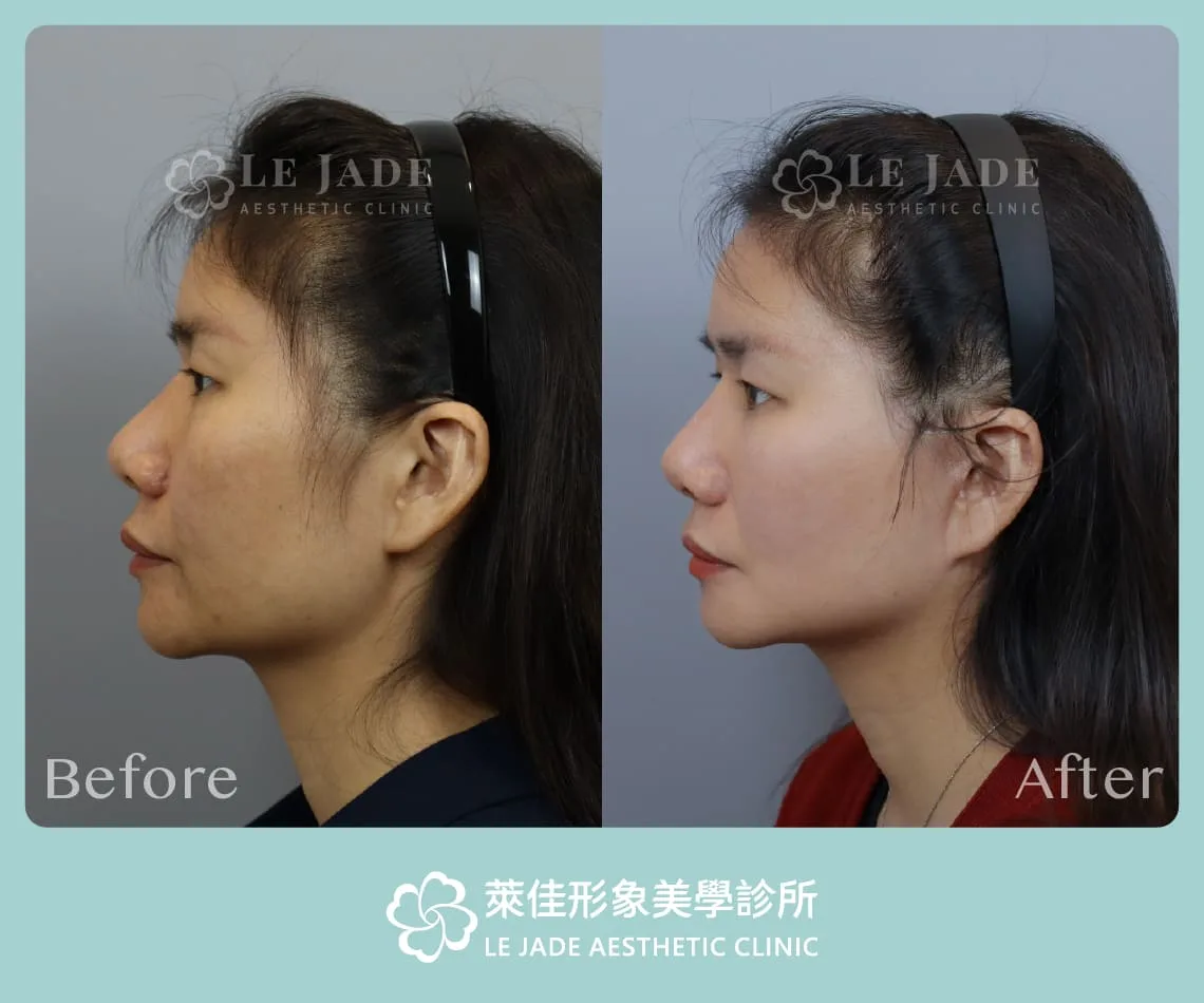 萊佳中下臉拉皮手術 術前術後對比照