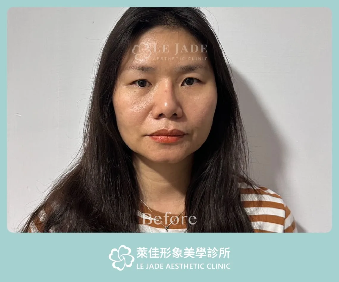 中下臉拉皮手術案例照 術前臉下垂鬆弛