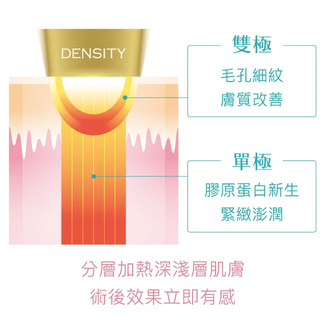 無雙電波的單極雙極治療