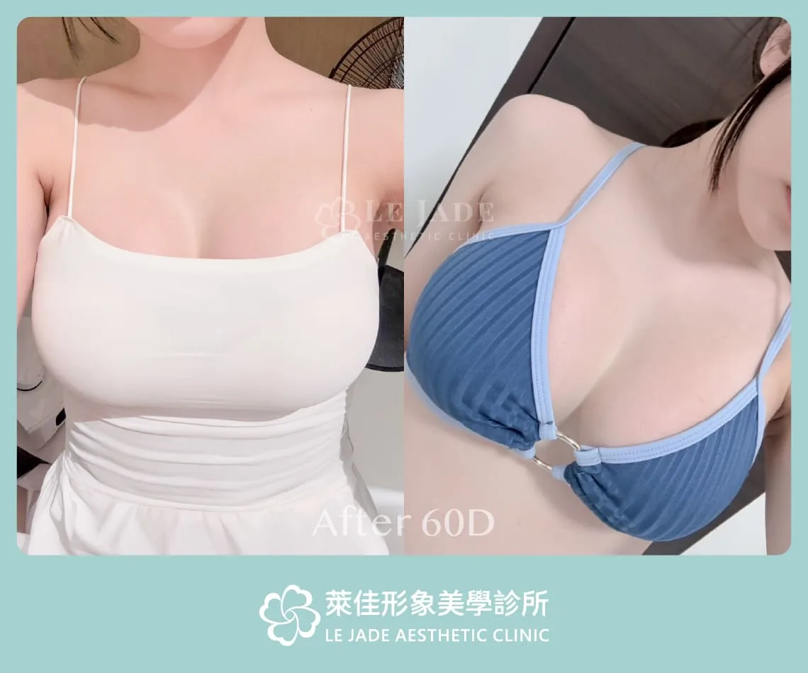 萊佳形象美學診所Motiva魔滴隆乳案例分享 術後照
