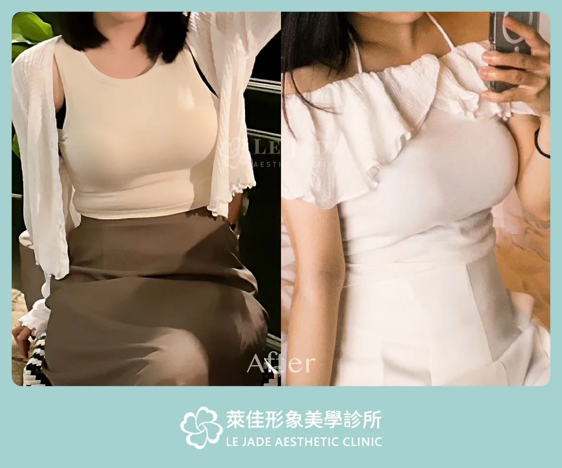 萊佳形象美學診所Motiva魔滴隆乳案例分享 術後照