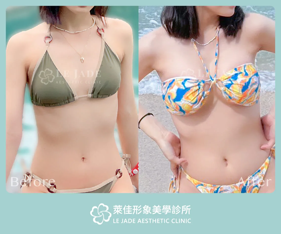 萊佳形象美學診所Motiva魔滴隆乳案例分享 術前術後照