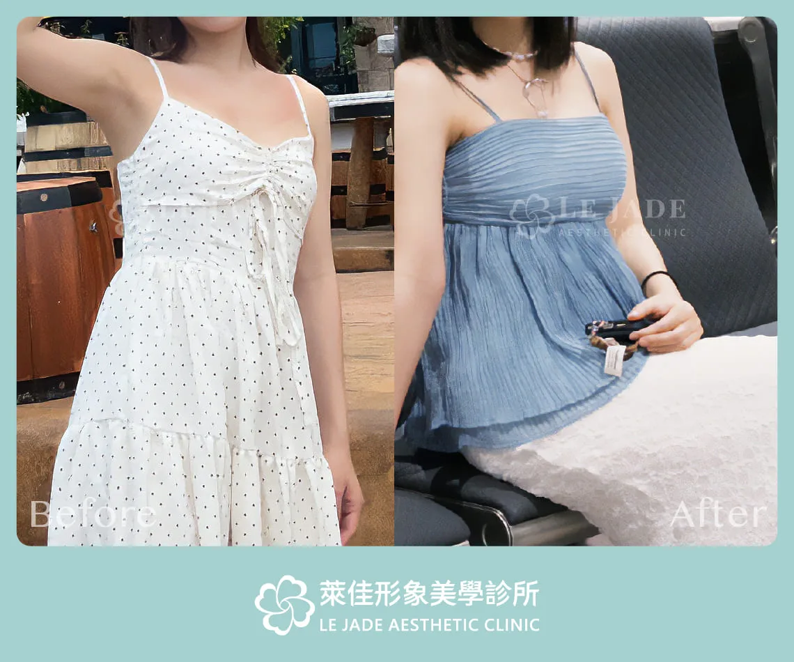 萊佳形象美學診所Motiva魔滴隆乳案例分享 術前術後照