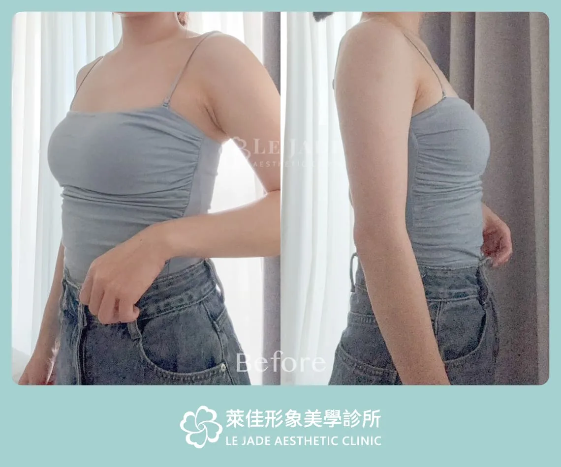 萊佳形象美學診所Motiva魔滴隆乳案例分享 術前照