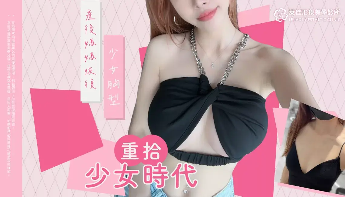 【隆乳推薦】產後媽媽恢復少女胸型,Motiva魔滴2.0+提乳手術案例分享