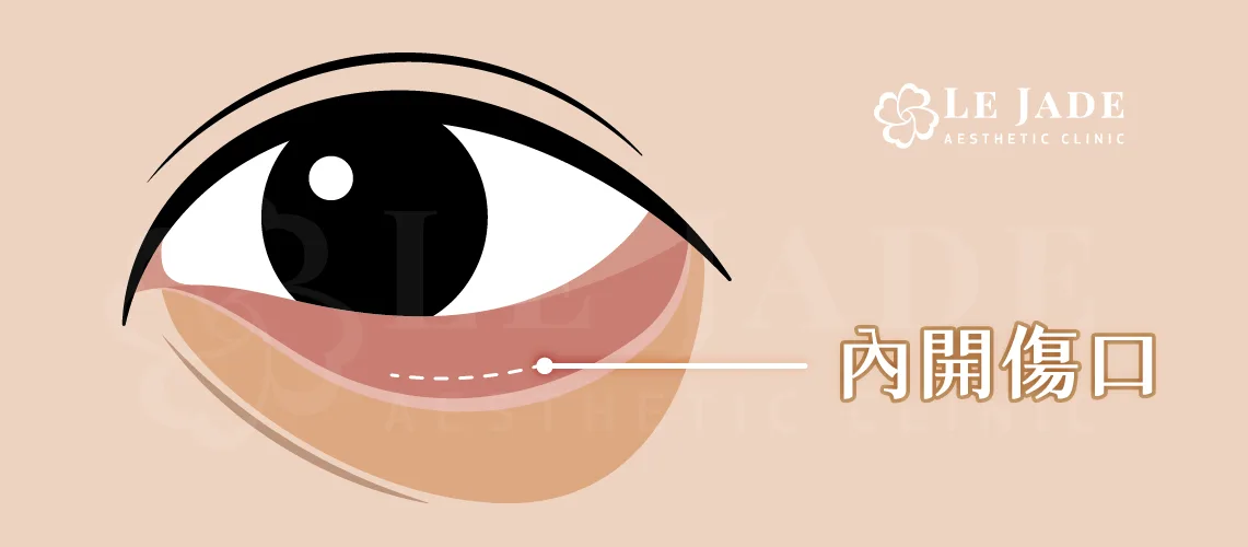 眼袋內開手術傷口位置