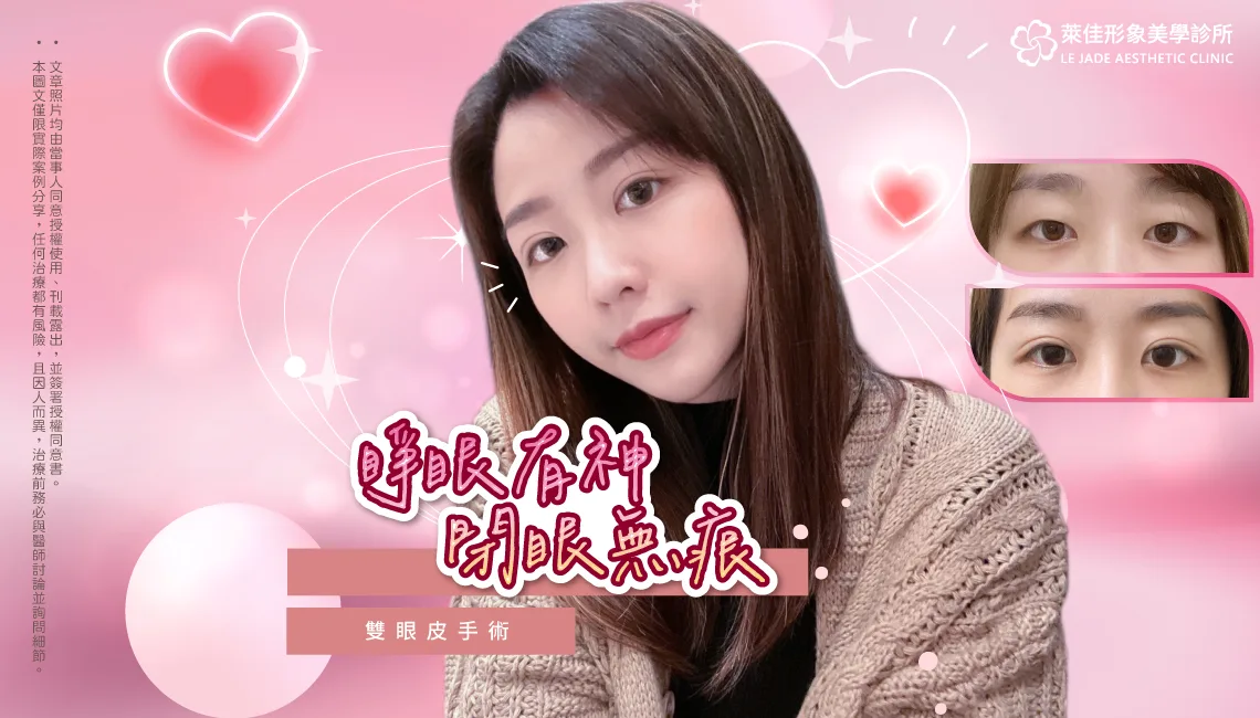 【縫雙眼皮】改造無神雙眼，升級眼睛神韻，縫雙眼皮案例分享