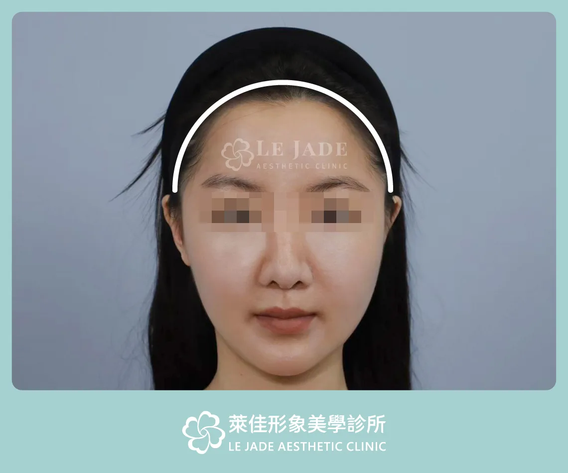 3D列印,完形美,豐額,太陽穴填補,凹臉,額頭線條示意
