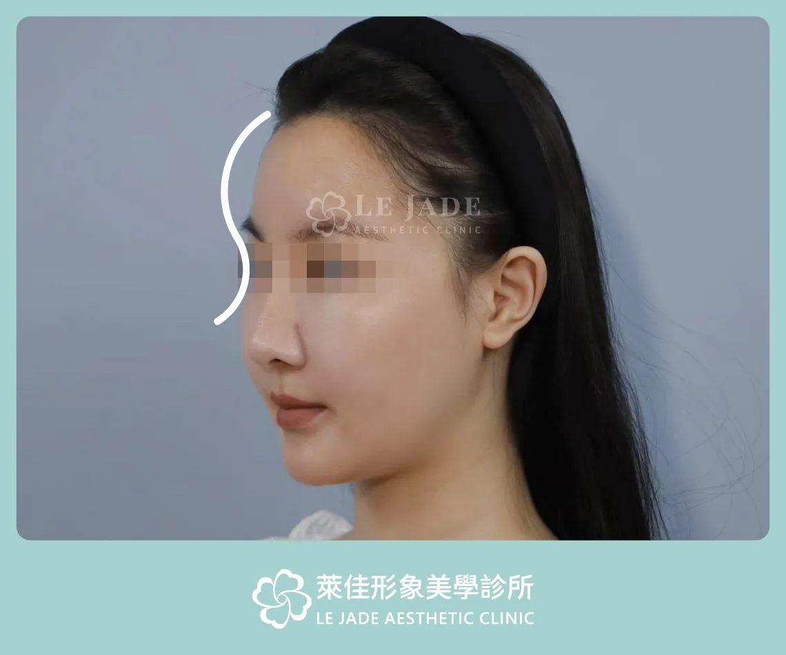 3D列印,完形美,豐額,太陽穴填補,凹臉,額頭線條示意