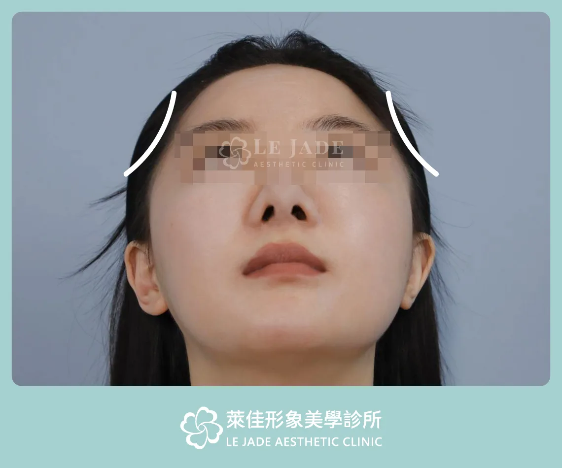 3D列印,完形美,豐額,太陽穴填補,凹臉,額頭線條示意