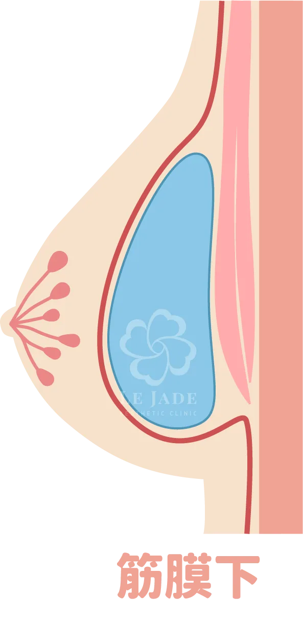 隆乳手術,隆乳放置位置,隆乳材質