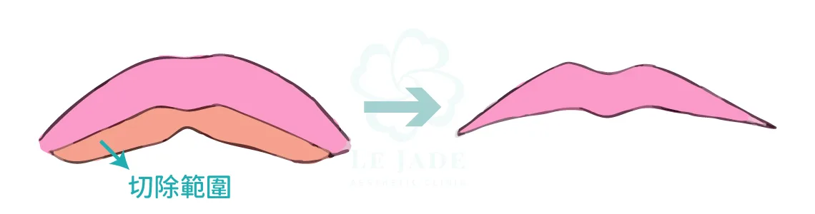 縮唇手術,縮唇,厚唇,微笑唇,厚唇縮小,縮唇微笑線,上下唇比例,客製化縮唇,薄唇雕塑