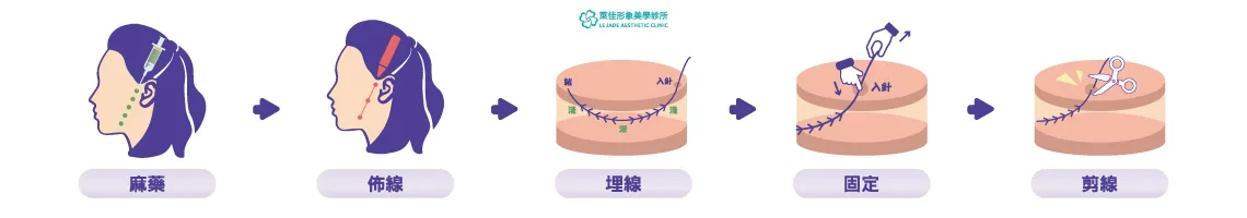 ”提美拉,美特拉,美特拉埋線,美特拉醫美,美特拉線材,美特拉埋線拉提,提美拉線雕,提美拉是什麼線"