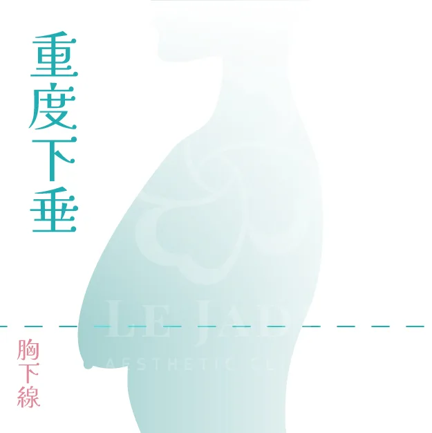 產後胸部下垂,產後胸部下垂怎麼辦,產後胸部下垂運動,產後胸部變小如何恢復,產後胸部下垂按摩,產后胸部下垂醫美